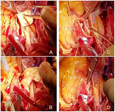 Reduction ascending aortoplasty: A retrospective analysis of outcomes and risk factors